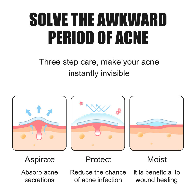 SEYE Acne Treatment Pads