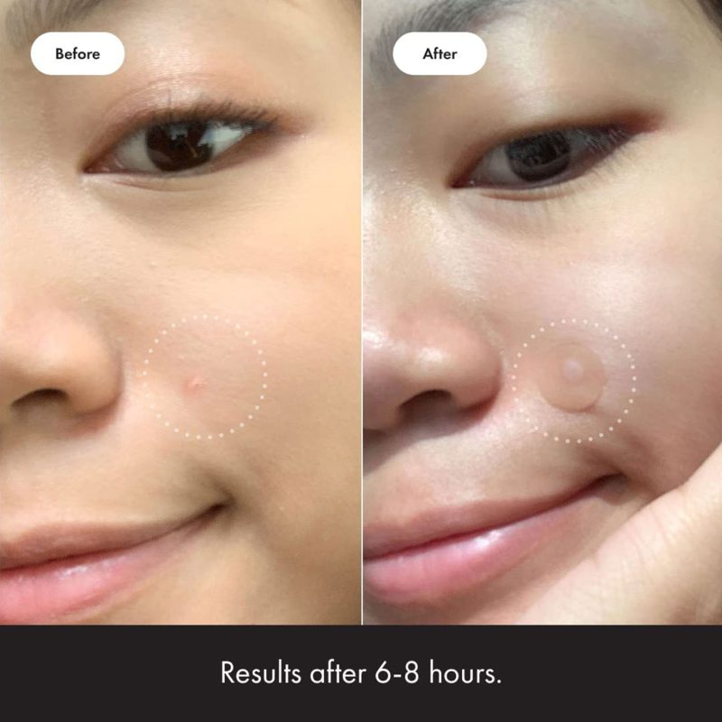 SEYE Acne Treatment Pads