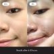 SEYE Acne Treatment Pads